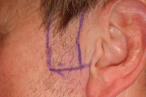 Sideburn-tranplant-before